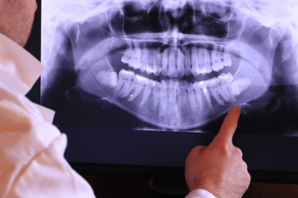 Best Emergency Tooth Extraction in Glencoe, AL