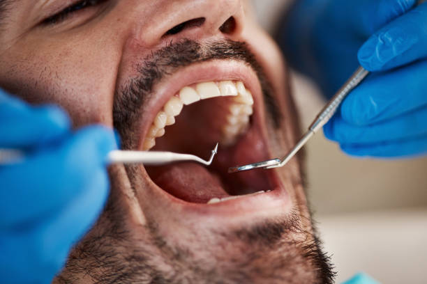 Best Emergency Wisdom Teeth Removal in Glencoe, AL